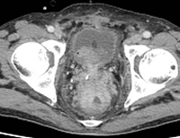 69歳　男性　大腸癌、多発性肝転移、膀胱転移消失