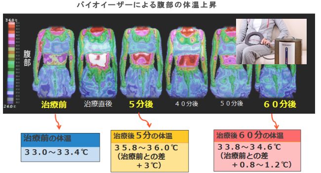 バイオイーザーによる腹部の体温上昇.jpg