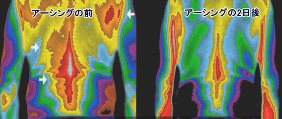 アーシングの効果「赤外線-肩と腰の炎症」