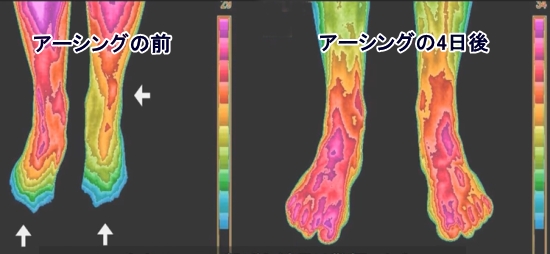 アーシングの効果「つま先の冷え」