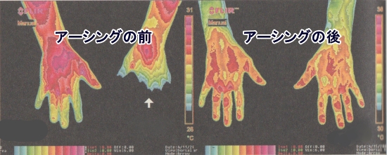 アーシングの効果「ゆび先の冷え」